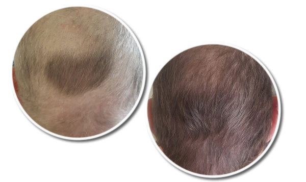 Lisa's Hair Loss Treatment Story