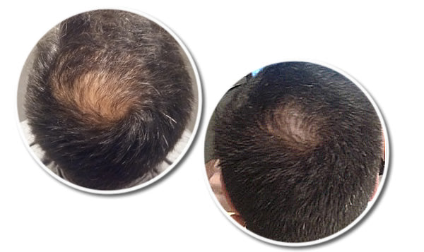 George's Hair Loss Case Study