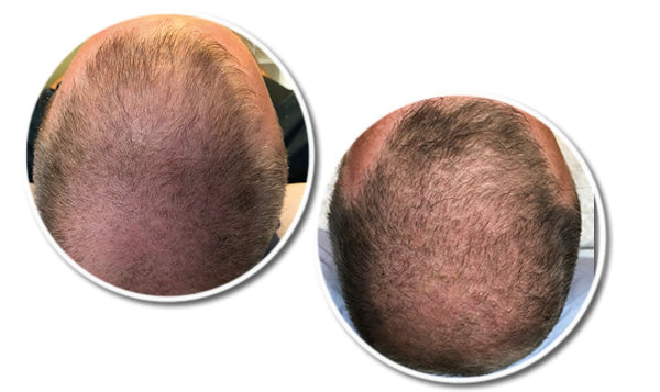 John's Hair Loss Treatment Story