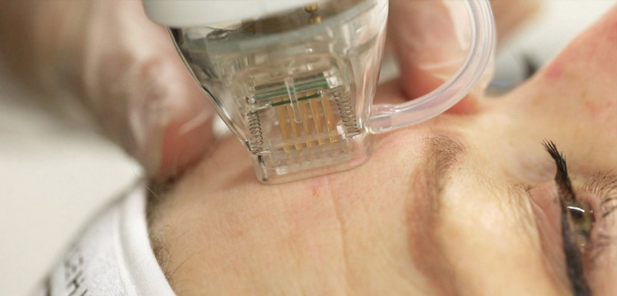 Fractional Microneedling RF - Medi-Nova
