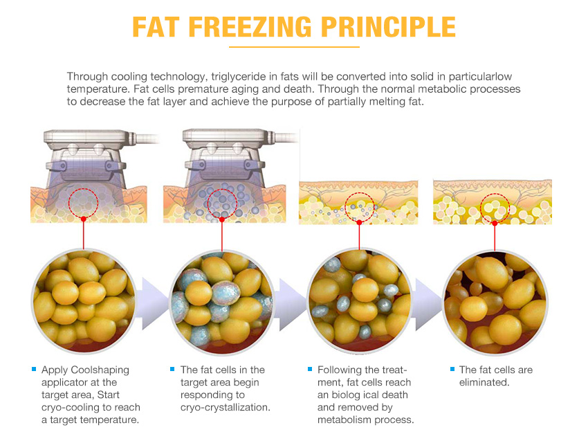 Fat Freeze Slimming Machine Cryolipolysis in Italy - Buy fat freeze ...