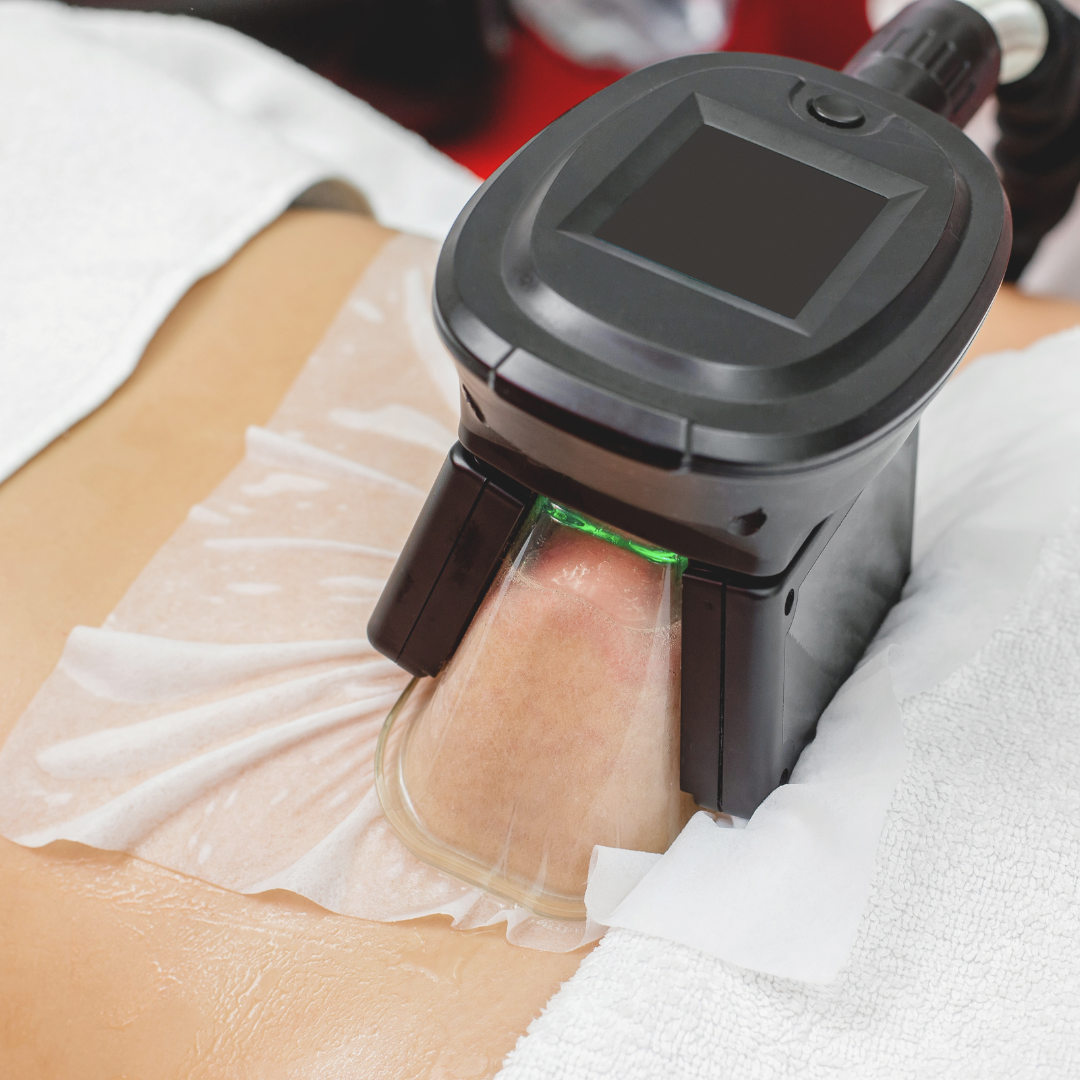 Cryolipolysis &mdash; Angelique Chromy Med Spa