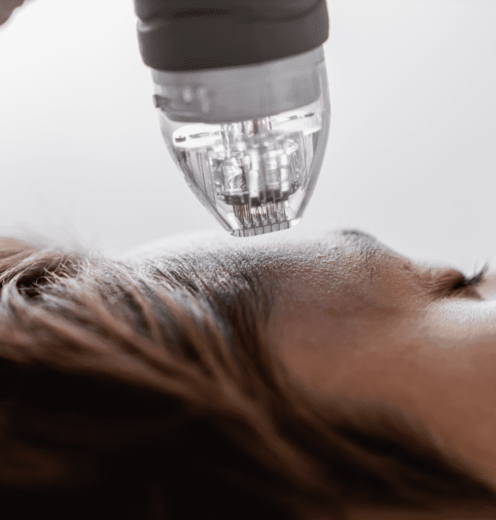 Microneedling RF Treatment in Sevenoaks | Prime Aesthetics