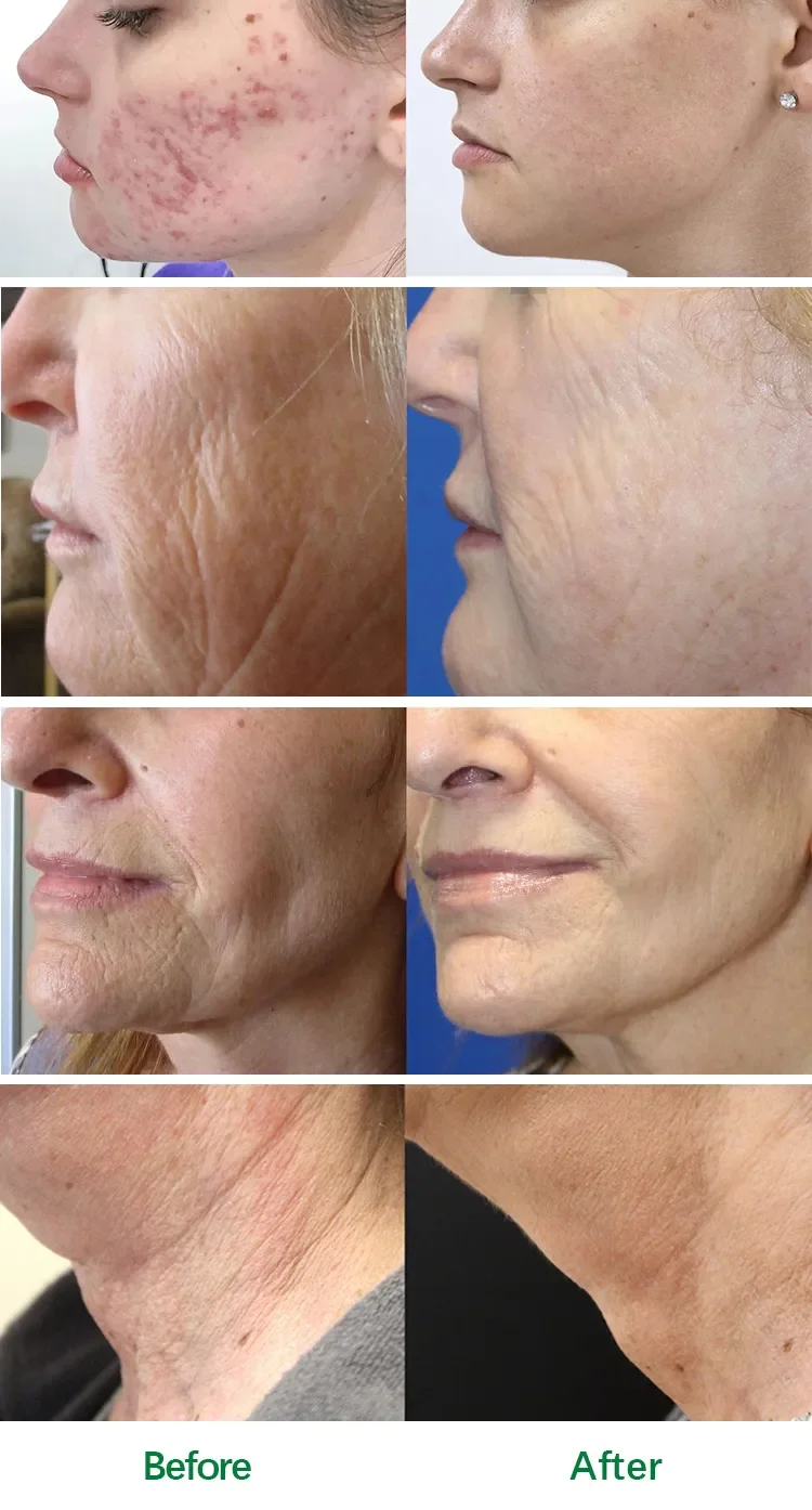 Skin Rejuvenation RF Secret Icy Gold RF Microneedling Machine ...