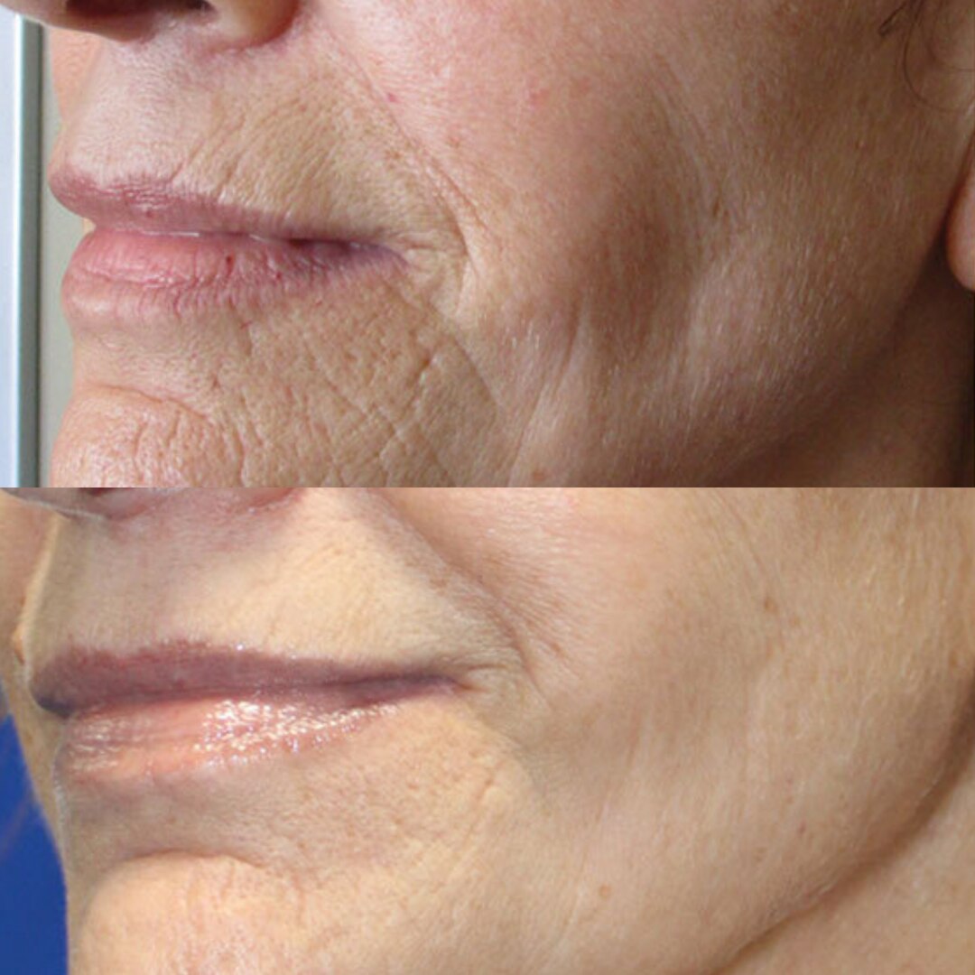 Radiofrequency Microneedling Before and After Photos - House of Beauty ...