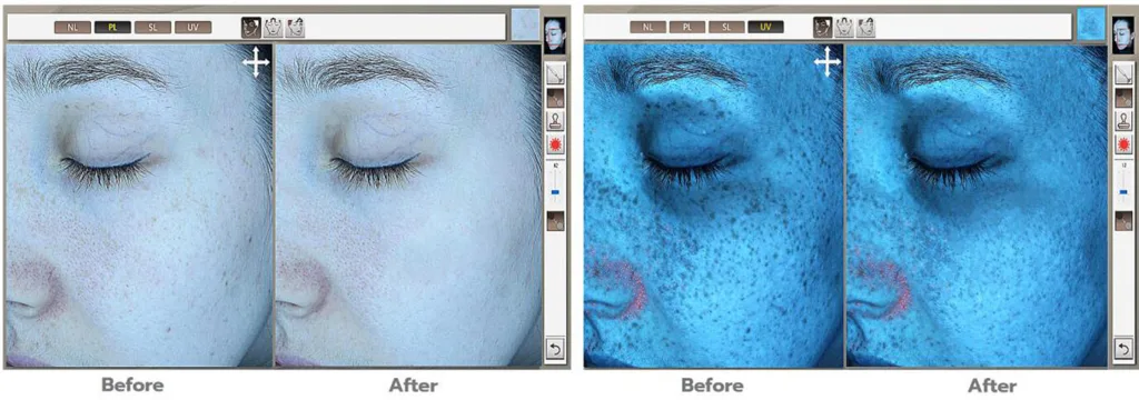 3D Facial Skin Analysis Technology | Digital Skin Scanning Machine ...