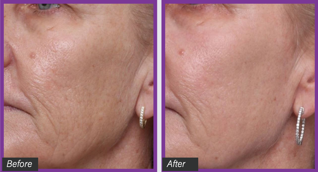 UltraClear&trade; Laser Treatment NYC | Dagan MD Facial Plastic Surgery