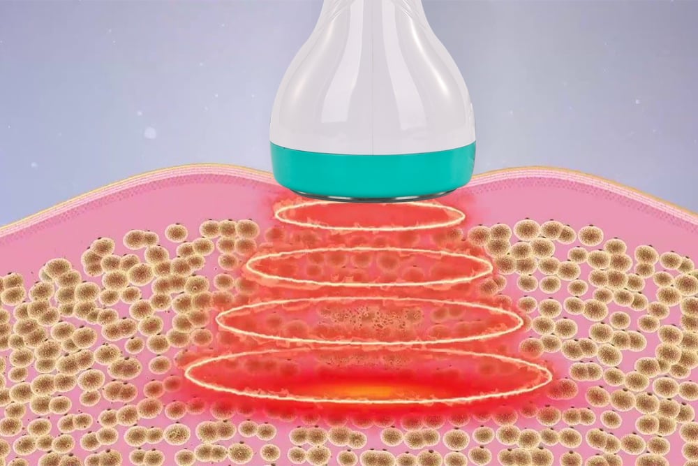 Ultrasonic Cavitation Before and After - konmison