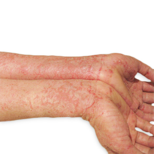 Eczema symptoms. Close-up of arms with red, cracked, inflamed skin, illustrating symptoms of eczema, psoriasis or dermatitis, suitable for skincare, sensitive skin and skin-condition awareness content.