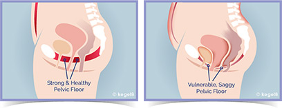 Pelvic Floor Comparison Chart. Side-by-side diagram comparing a strong, healthy pelvic floor with a weak, saggy pelvic floor, showing how muscle support affects pelvic organ position