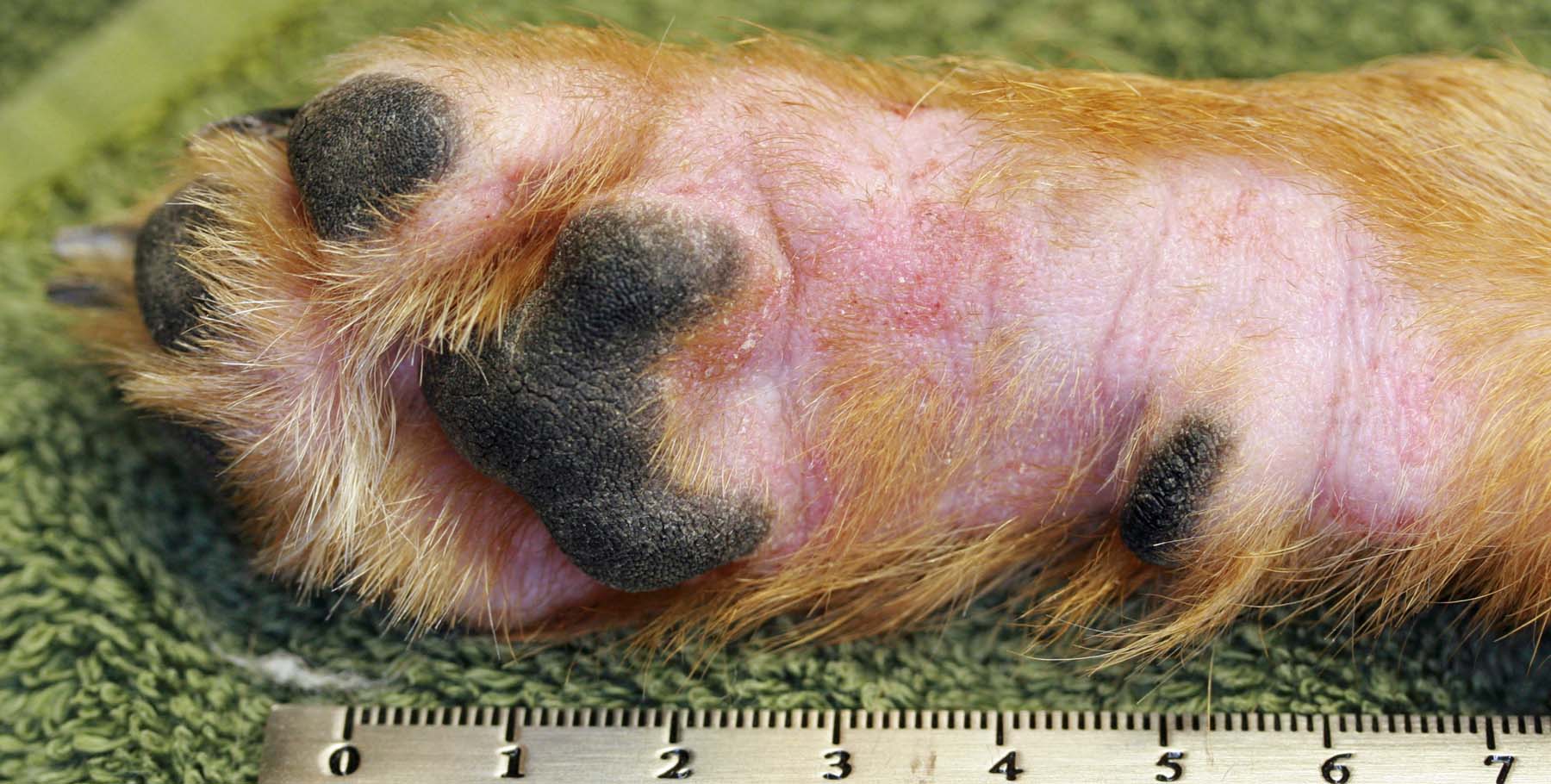 Atopic Dermatitis